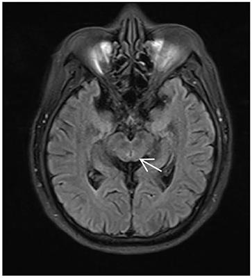 Ornidazole-Induced Recurrent Encephalopathy in a Chinese Man: A Rare Case Report and Literature Review